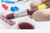 Napravite tumorski marker za žene ili muškarce i otkrijte tumor na vrijeme!