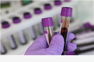Komplet laboratorijskih pretraga iz krvi i urina u Poliklinici Salzer