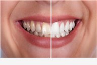 Nesigurni ste u svoj osmjeh? Odlučite se za izbjeljivanje ZOOM tehnologijom, čišćenje zubnog kamenca i poliranje profesionalnom pastom uz GRATIS pregled i konzultacije - Sigurna i bezopasna metoda kojom se u prosjeku postižu 3 - 4 nijanse svjetliji zubi ODMAH