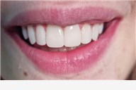 Ispravite oblik, boju, veličinu ili položaj zuba uz uveneer kompozitne ljuskice + pregled te bez skrivanja pokažite svoj novi osmijeh - Tretman izvodi dr. med. dent. Maja Marić iz Dental studija Marić